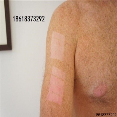 強(qiáng)脈沖光真OPT的辨別，附大量實例對比